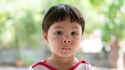 5 Paraan Para Maiwasan Ang Peklat Ng Bulutong .